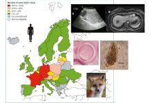Echinococcosi alveolare casi